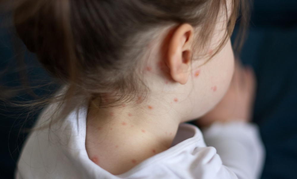 Улаанбурхан өвчний батлагдсан тохиолдол 13140 болжээ